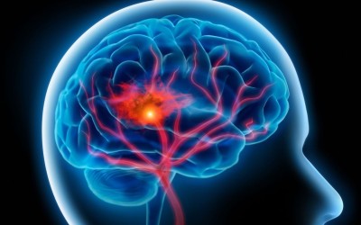 Nước ion kiềm có thể giúp phòng chống nguy cơ đột quỵ không?